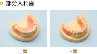 レジン床義歯 保険適応