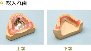 金属床義歯  自費診療