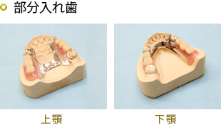 金属床義歯  自費診療